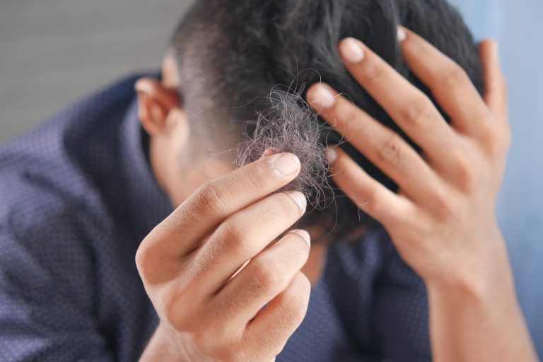 Alopecia MAGA: ¿Qué es y cuáles son sus síntomas?