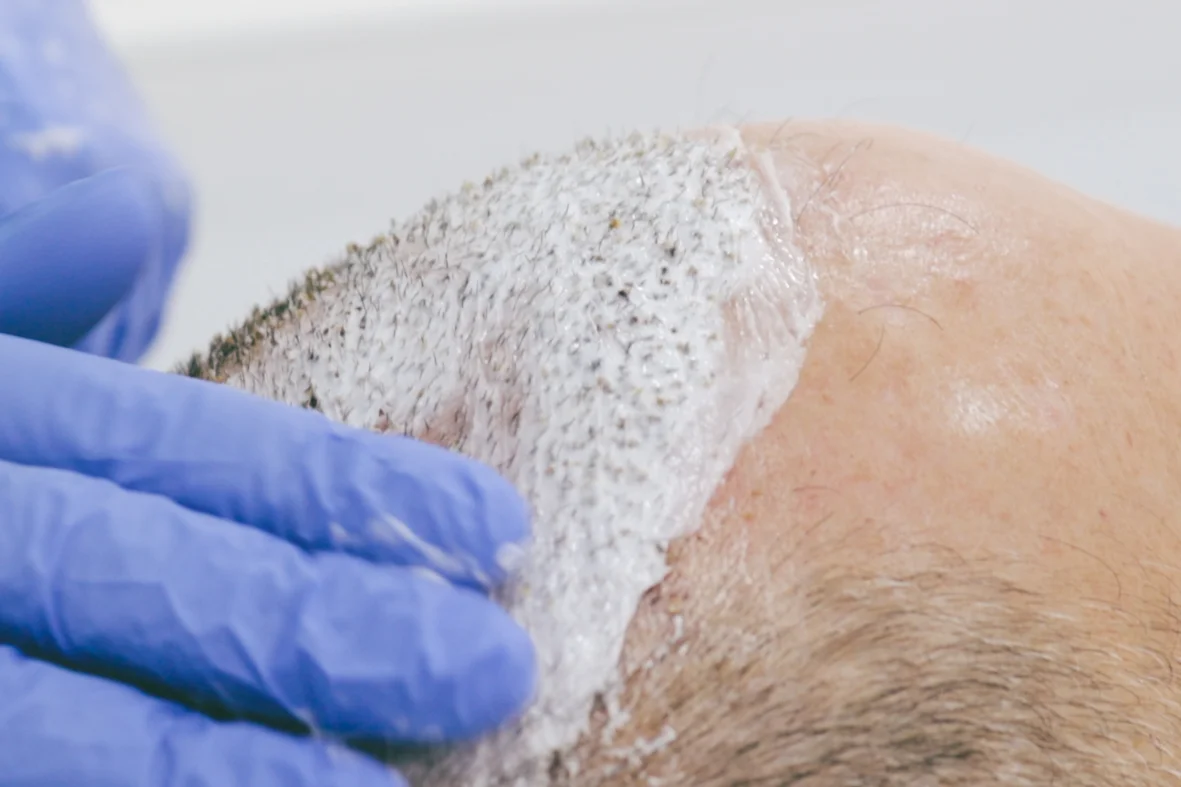 Shampoo for after hair transplant