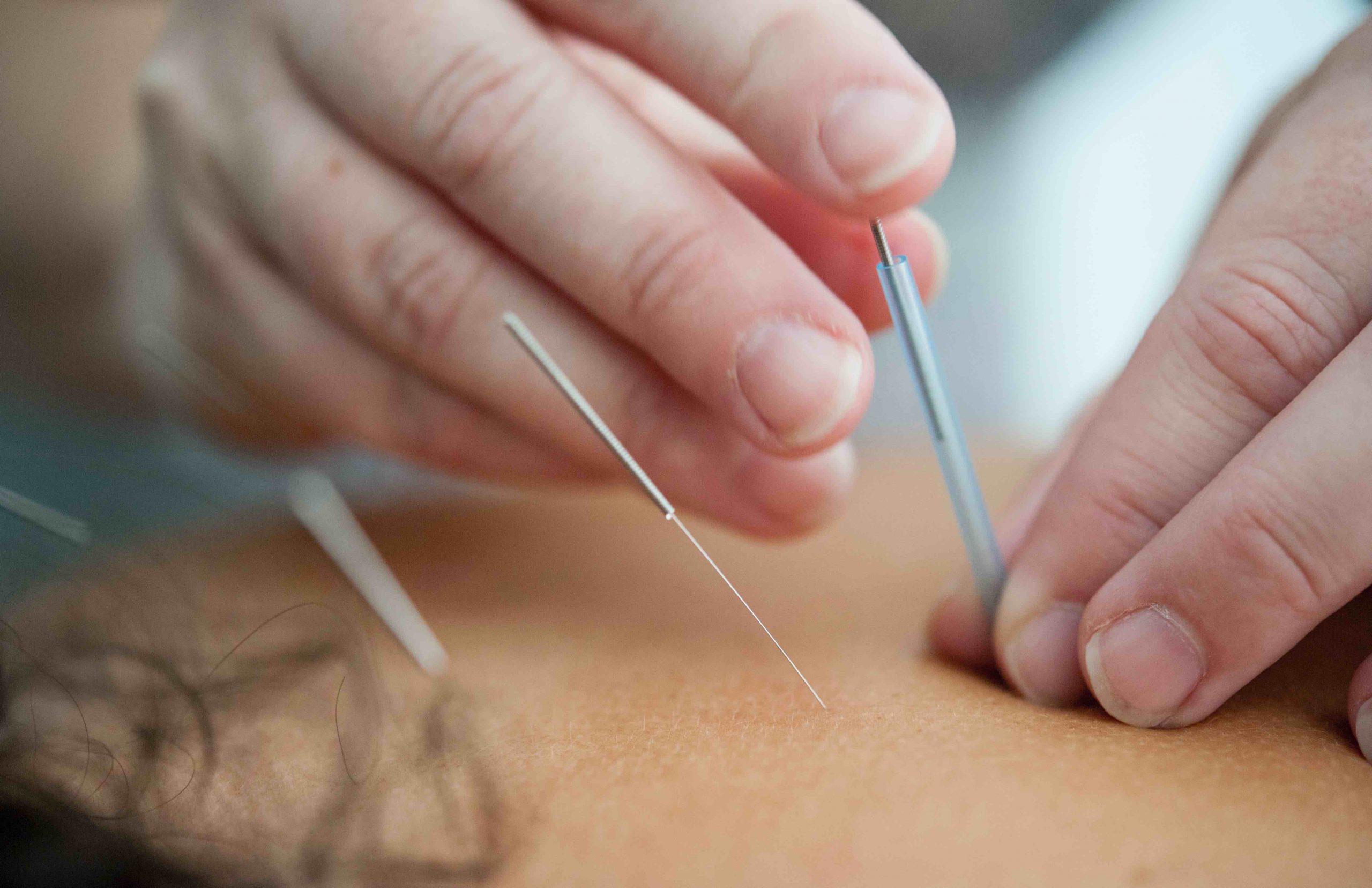 ACUPUNCTURE FOR HAIR LOSS: Does it work?