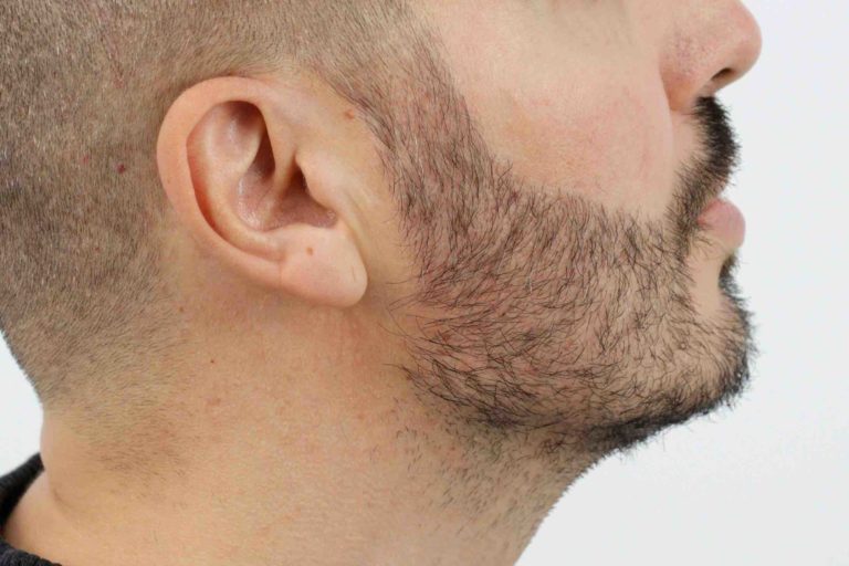 Resultados de un injerto de barba