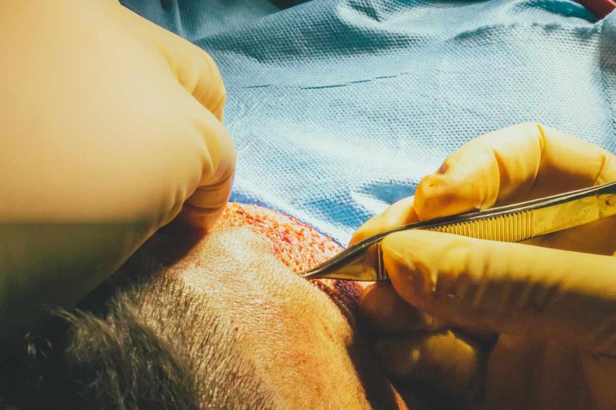 Sanitario implantando folículos en un injerto de cejas