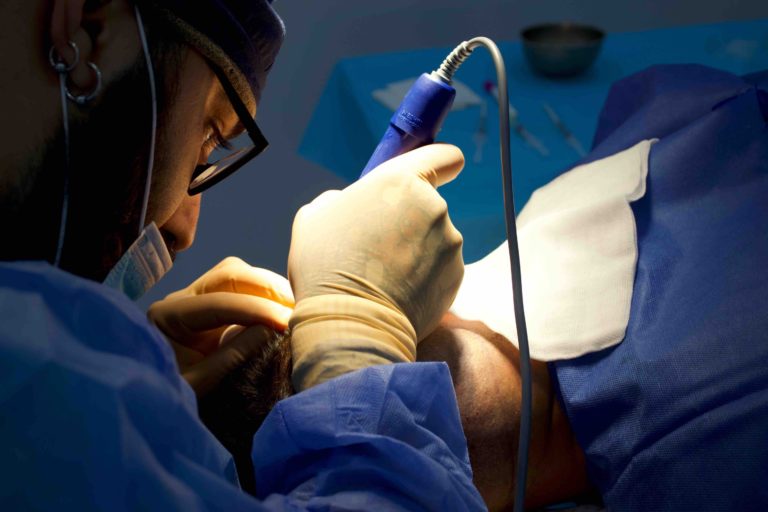 Sanitario realizando la extracción de folículos en en paciente de injerto capilar con pelo graso
