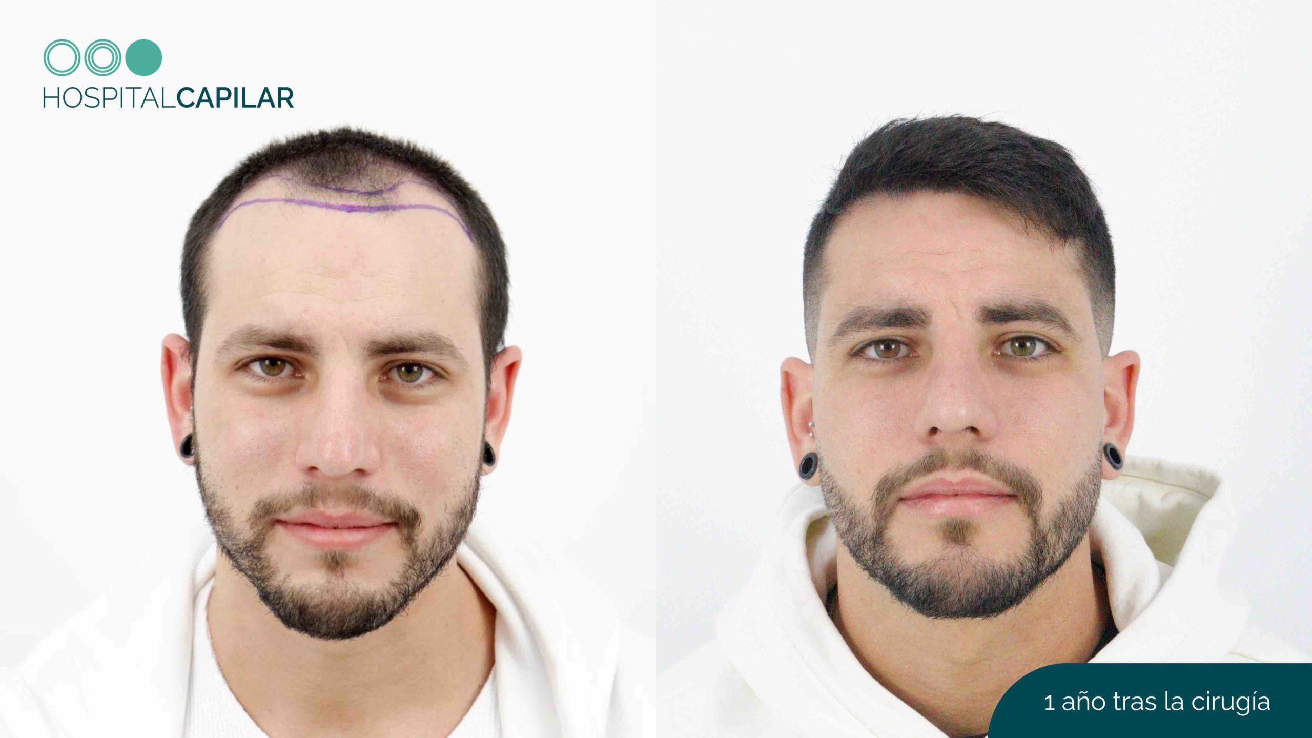Paciente de antes y después de su injerto capilar en Madrid